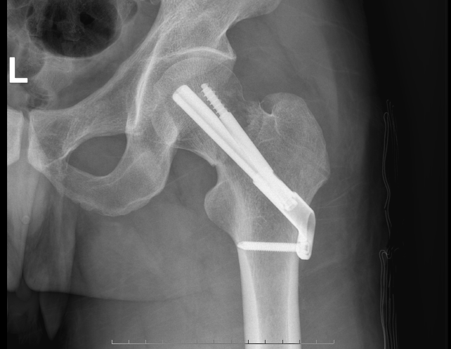 争做搏击时代的排头兵——我院骨二科吴斌主任团队运用“FNS”（股骨颈动力交叉钉系统）微创治疗股骨颈骨折
